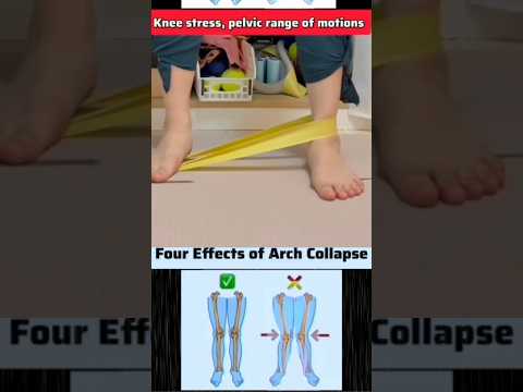 انهيار قوس القدم وتأثيره الصاعد من إجهاد الركبة إلى تشوه العمود الفقري وفقدان استقرار الحوض.